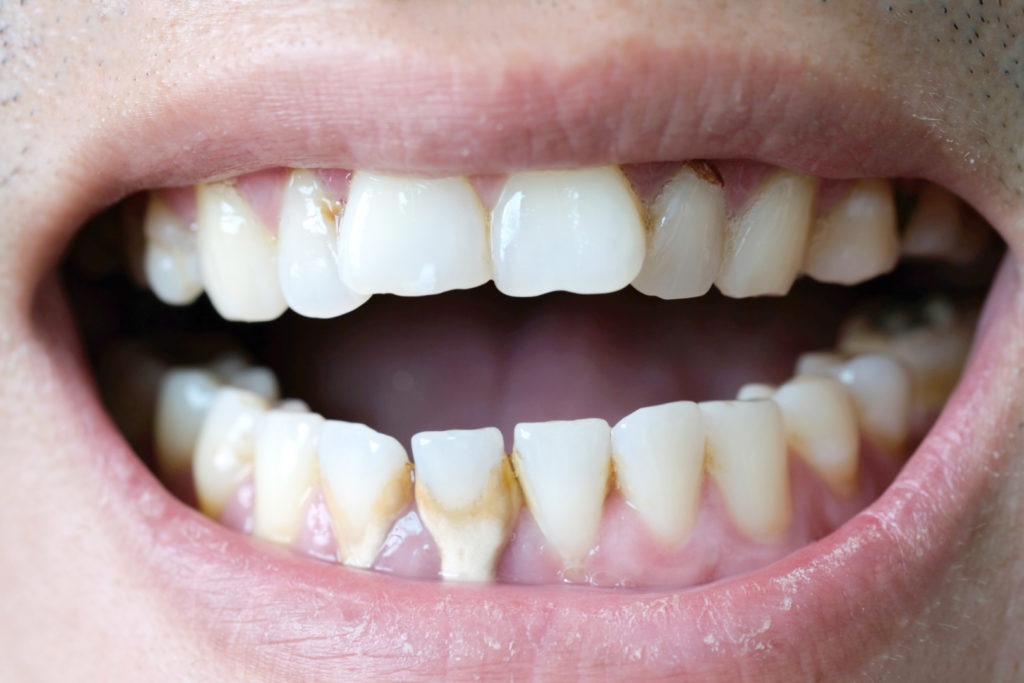 Citlivé zuby môžu vyvolať intenzívnu bolesť  po kontakte so studeným alebo teplým jedlom